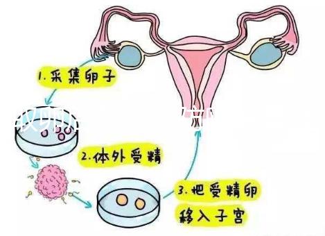 取卵后怎么預防卵巢囊腫？5種科學方法值得學習