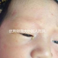 優(yōu)勢卵泡大小因人而異,醫(yī)生表示1.8