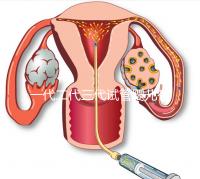 一代二代三代試管嬰兒有什么區別？