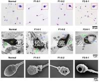怎么樣預(yù)防乳腺癌（什么人容易得乳腺癌）