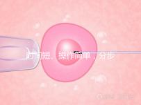 時間短、操作簡單，分步驟解讀宮頸擴張術全過程