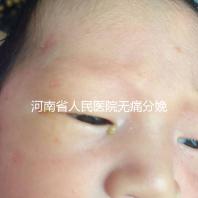 河南省人民醫院無痛分娩多少錢戳，收費標準60s看懂不踩坑