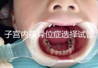 子宮內膜異位癥選擇試管嬰兒有3大理由,成功率是其一