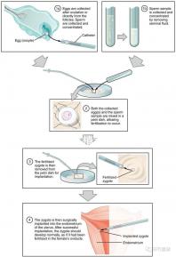 試管嬰兒移植手術（試管嬰兒移植手術需要多長時間）